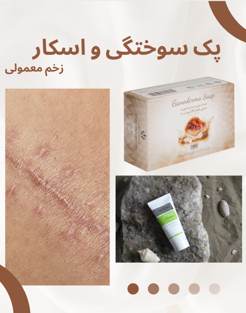 پک سوختگی و اسکار معمولی