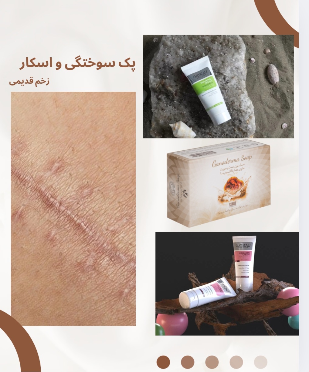 پک سوختگی و اسکار ۱۰ ساله